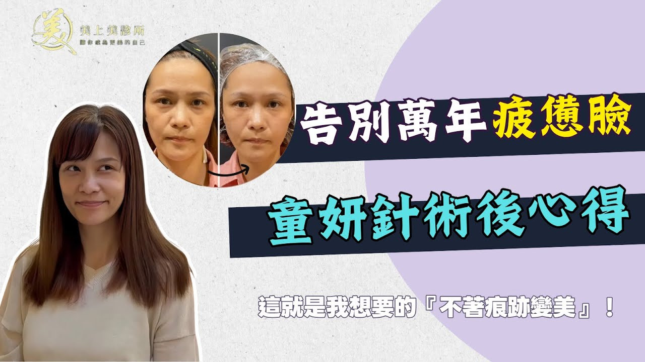 童妍針心得。